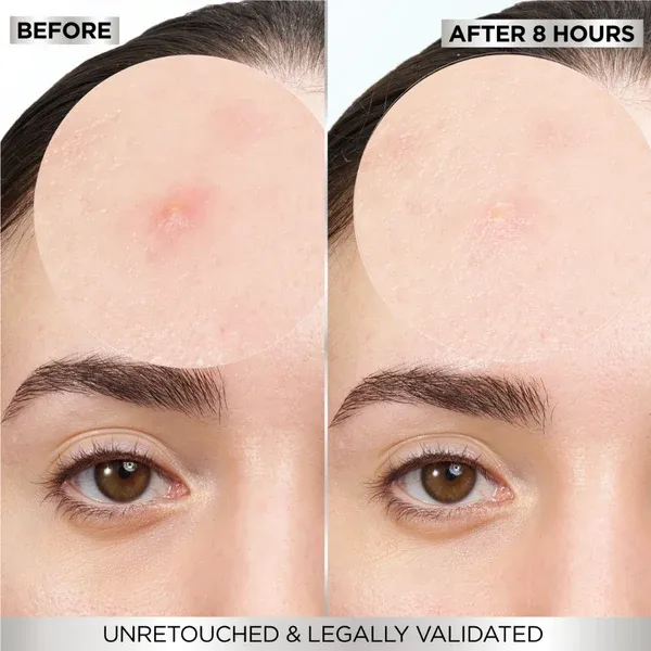 GarnierSkinActiveFastClearInvisiblePimplePatch8HoursHydrocolloid22Patchesvisulresultsbeforeandafter.webp