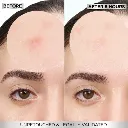 GarnierSkinActiveFastClearInvisiblePimplePatch8HoursHydrocolloid22Patchesvisulresultsbeforeandafter.webp
